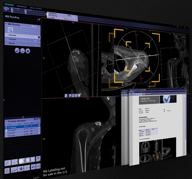 syngo.via VA30 автоматично идентифицира и маркира ребрата при сканиране с компютърен томограф