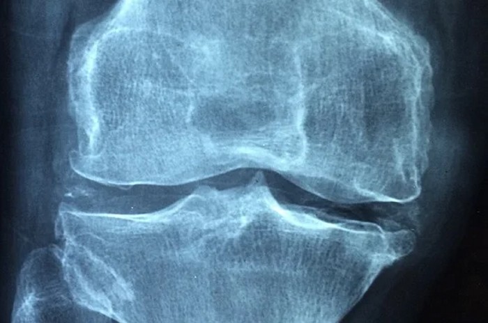 AI може да чете по прецизно рентгеновите снимки на коляното отколкото